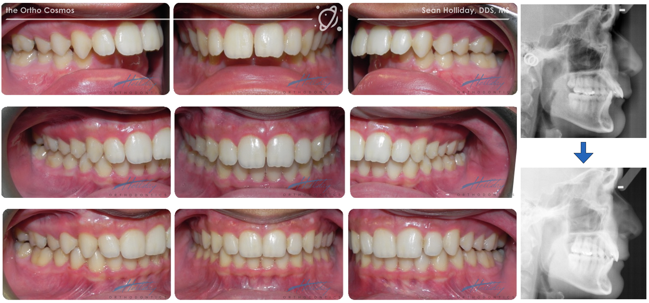 Can Braces Fix Occlusion