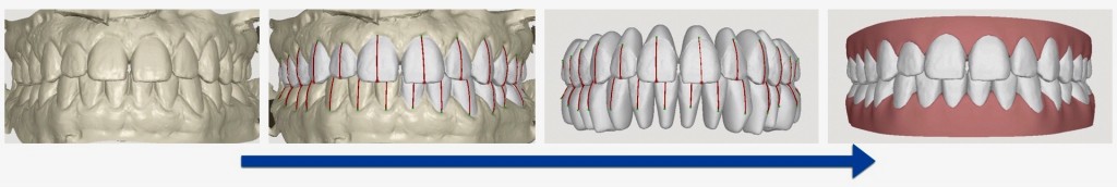 Aligner Steps.001