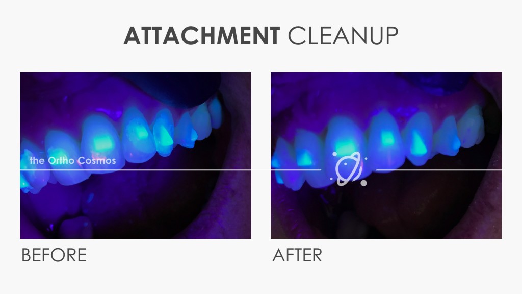 Invisalign Attachment Flash Cleanup