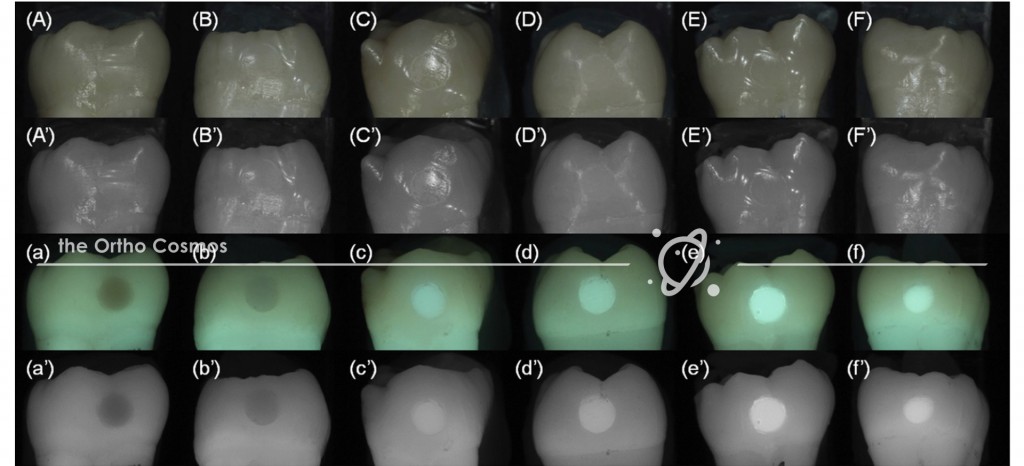 Invisalign Attachment Fluorescence