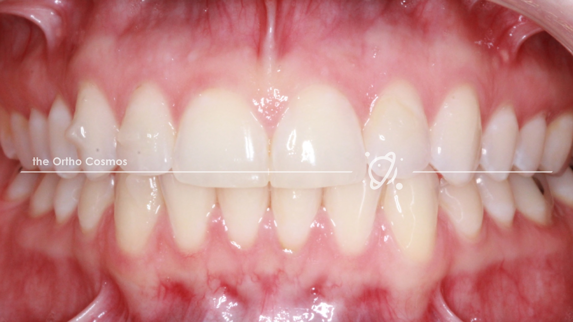 Evaluating Invisalign Tracking & Attachment Flash - The Ortho Cosmos