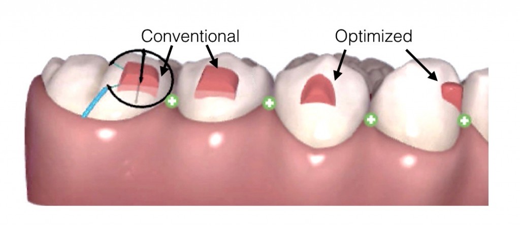 Decoding Invisalign's Optimized Attachment & Optimized Feature