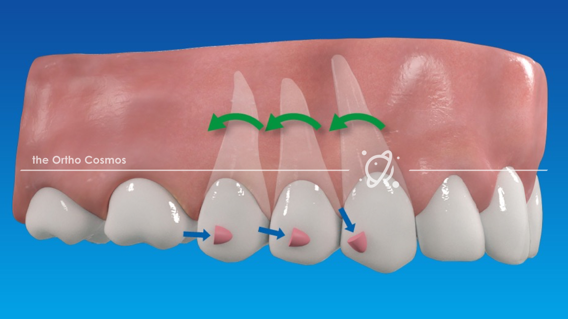 Traditional Attachments vs Aligner Optimization - The Ortho Cosmos