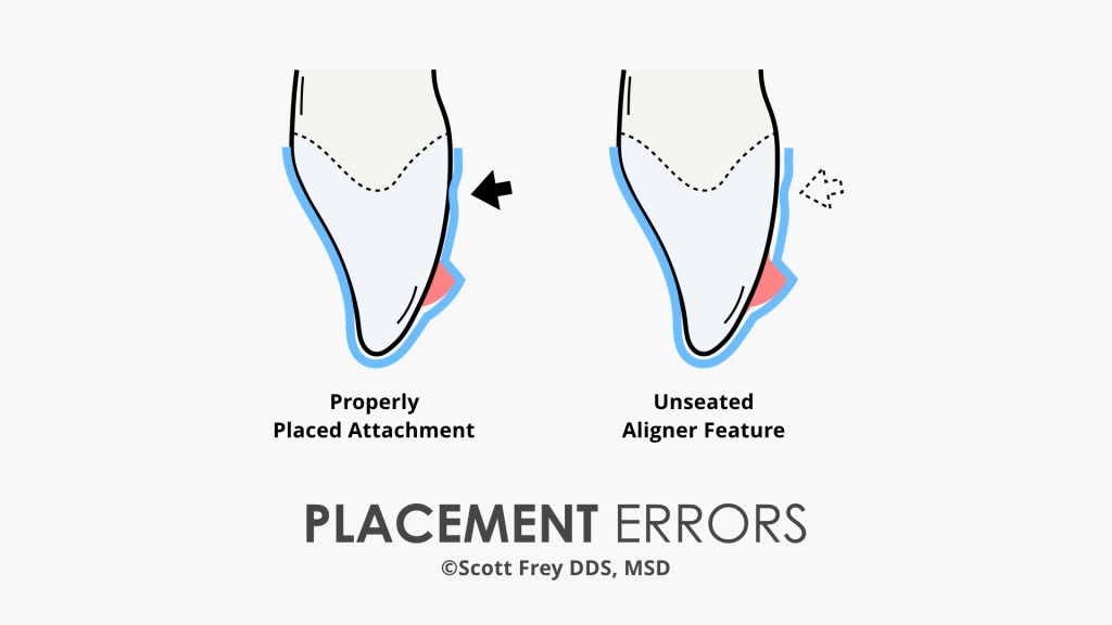 Optimized Attachment Placement Error