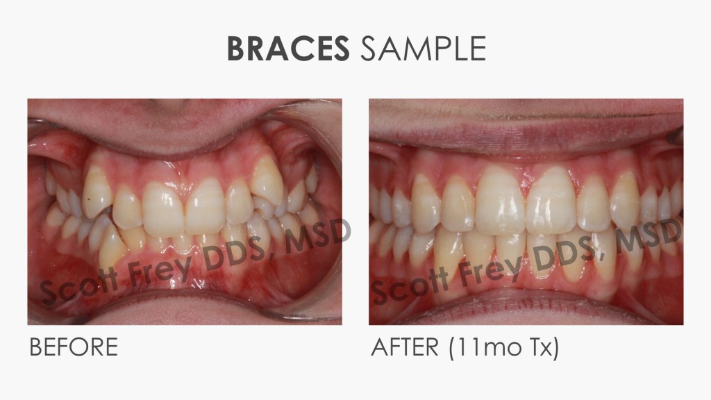 Braces Sample Before & After