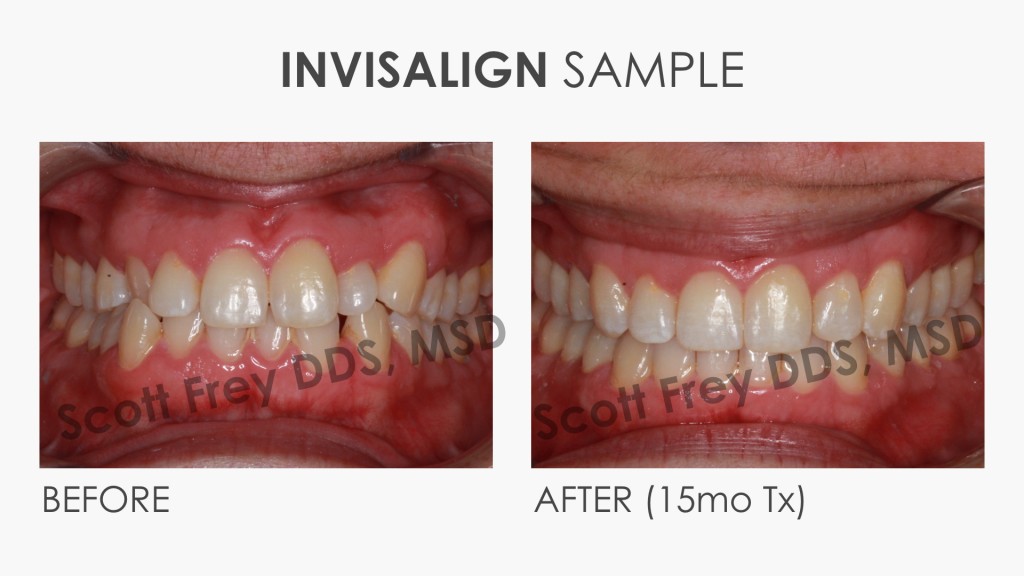 Invisalign Sample Before & After