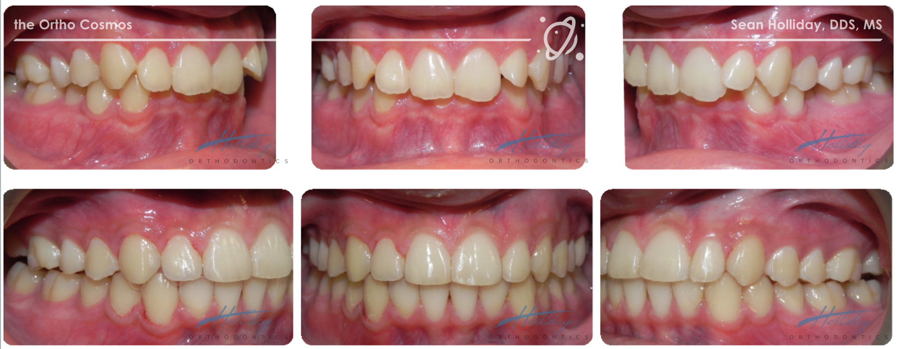 Can We Treat Challenging Malocclusions with Invisalign ...