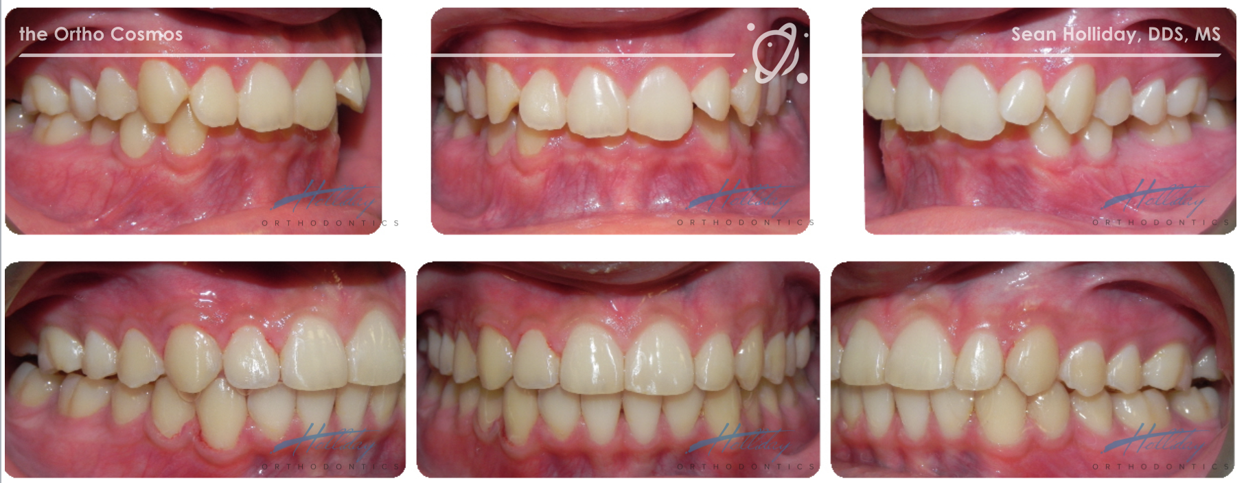 Can We Treat Challenging Malocclusions with Invisalign? - The Ortho Cosmos