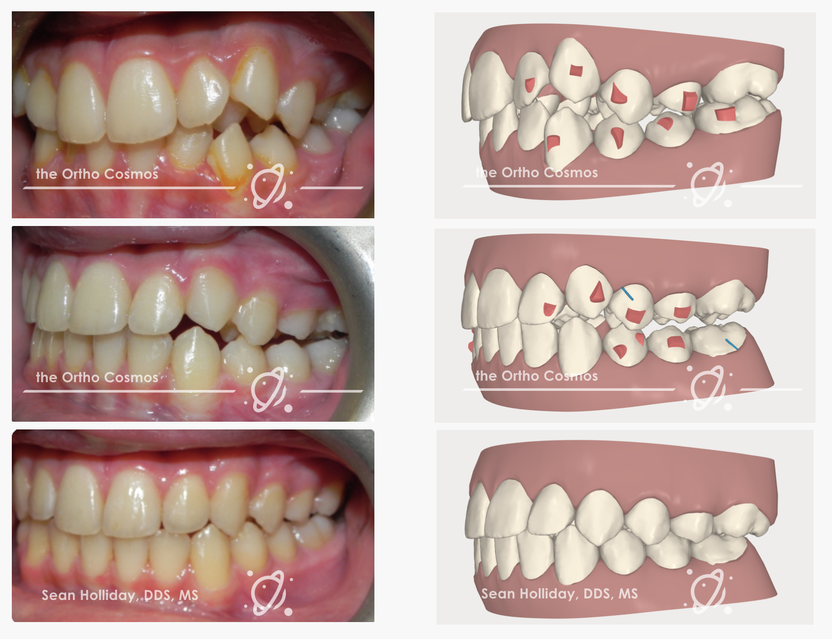 Posterior Openbites with Aligners - The Ortho Cosmos