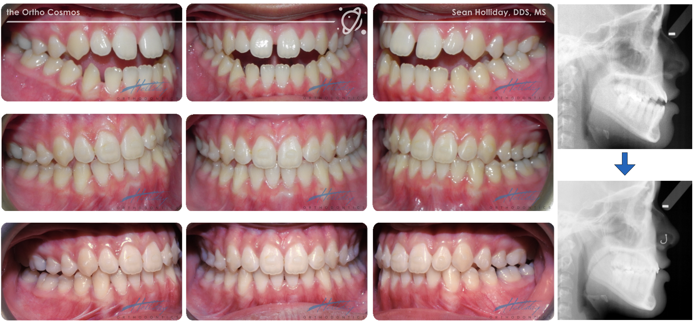 Class 3 Malocclusion Treatment With Invisalign