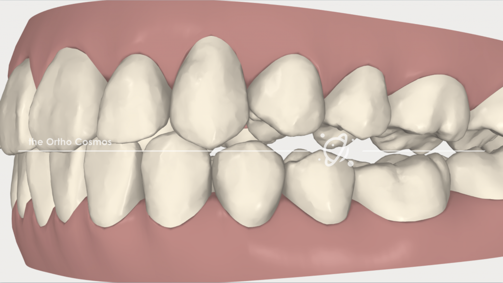 Posterior Openbite