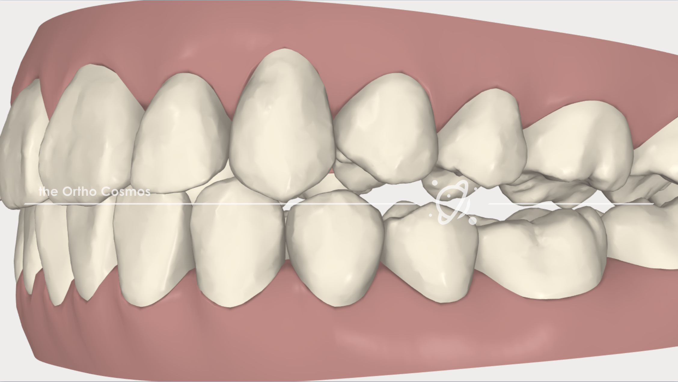 Posterior Openbites with Aligners - The Ortho Cosmos.