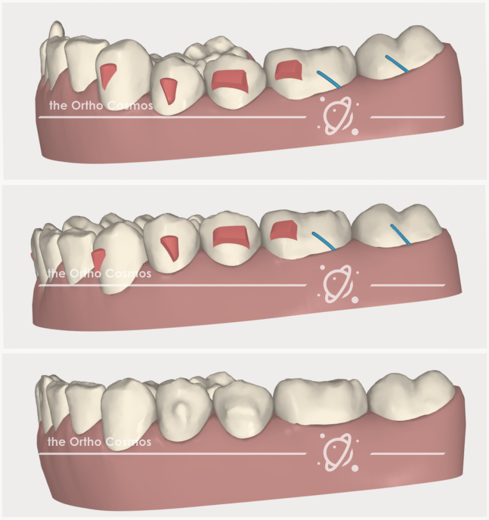 Posterior Openbites with Aligners - The Ortho Cosmos.