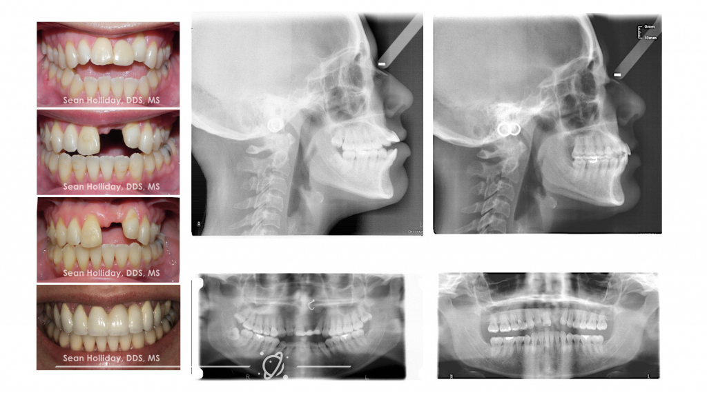 Molar intrusion 1