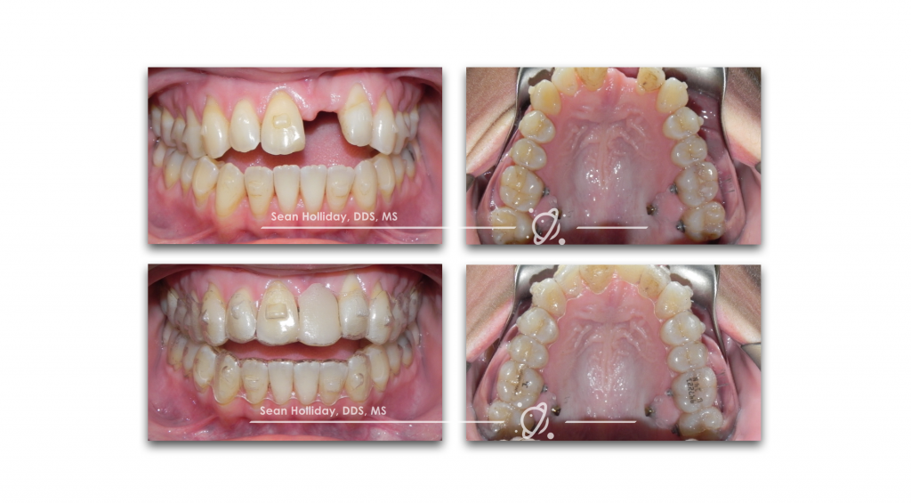 Molar intrusion 2