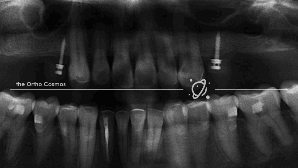 TADs and Aligners