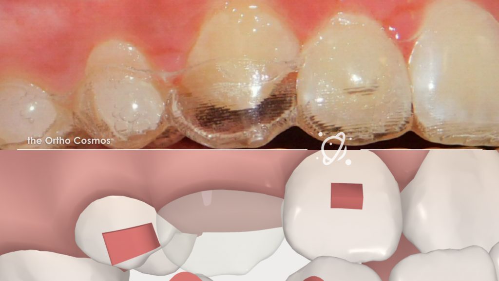 Aligner tooth eruption