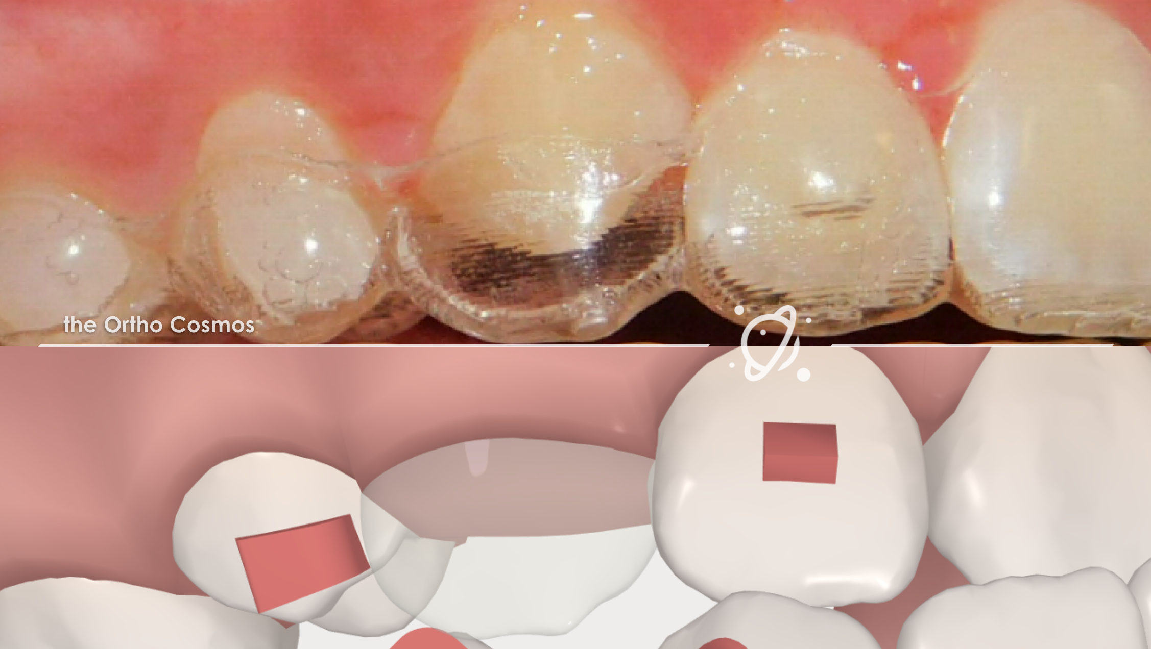 Erupting Dentition in Aligner Therapy