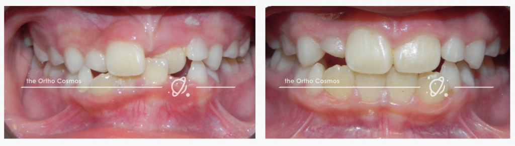 Anterior crossbite