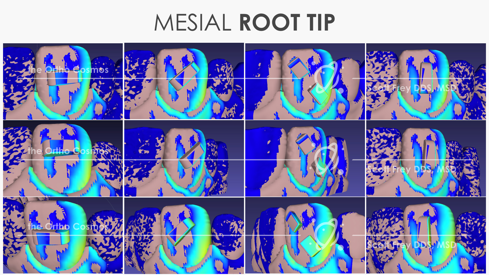 Evaluating Invisalign Tracking & Attachment Flash - The Ortho Cosmos